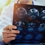 Casos de AVC aumentam no país e reforçam alerta sobre prevenção e monitoramento da saúde